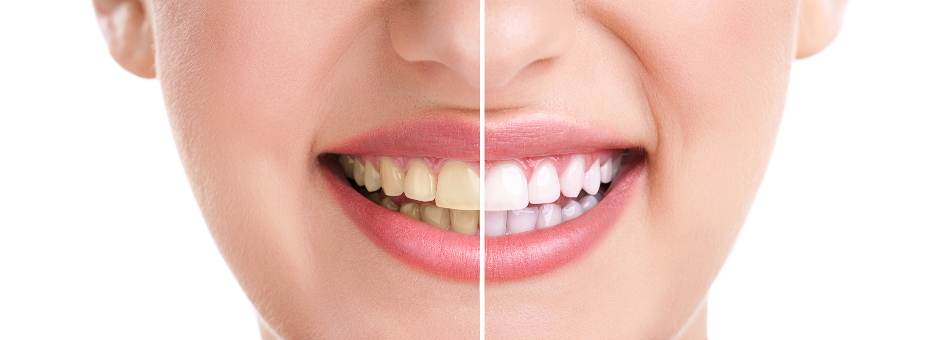 The image shows a close-up of a person s face with a big smile, highlighting their teeth, which are noticeably yellowed.