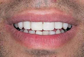 Howard County Family Dentistry | Teeth Whitening, Dental Sealants and Crowns & Caps
